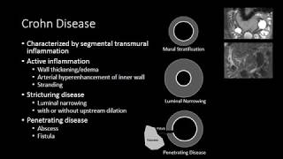 Small Bowel Inflammation [upl. by Jurdi]