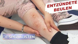 Beulen an den Beinen Parasitenbefall  Auf Streife  Die Spezialisten  SAT1 TV [upl. by Sicnarf]